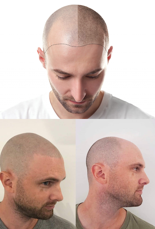 Scalp Pigmentation Before After